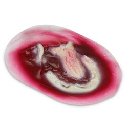 Wound, Avulsion, Stick-On, Major, 8 x 5 cm
