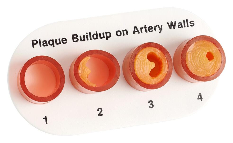 Nasco Healthcare Artery Section with Blockage Model