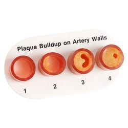 Nasco Healthcare Artery Section with Blockage Model