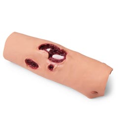 Compound Fracture, Tibia