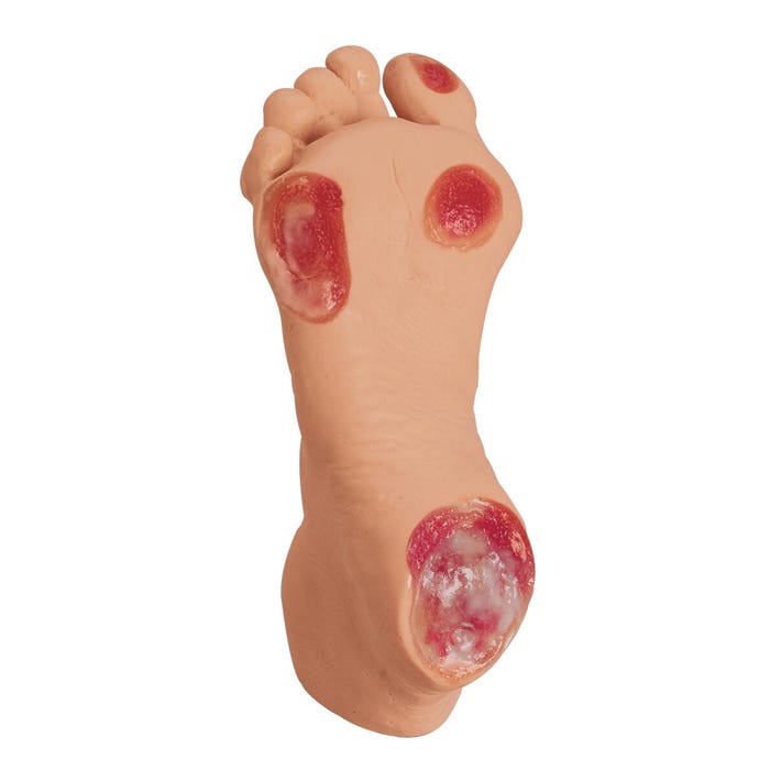 Life/form® Elderly Pressure Ulcer Foot - Light