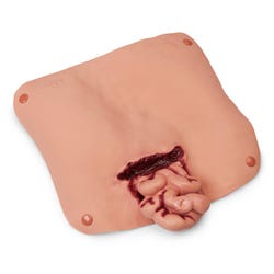 Abdominal Wound