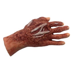 Chemical Burn, 4Th Degree, Right Hand