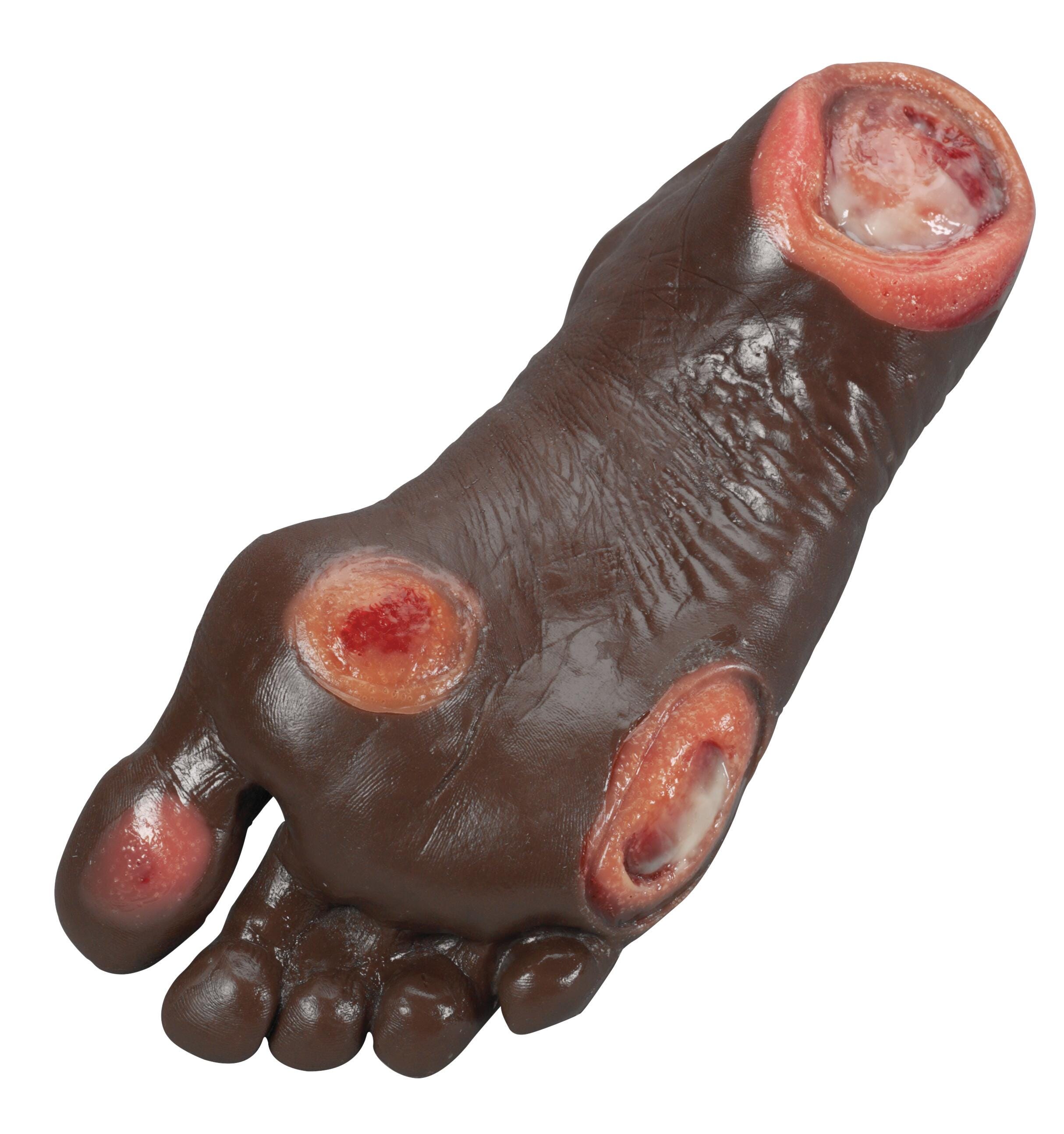 Life/form Elderly Pressure Ulcer Foot, Dark