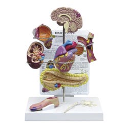 Gpi Anatomicals Type 2 Diabetes Models, 10 Inches