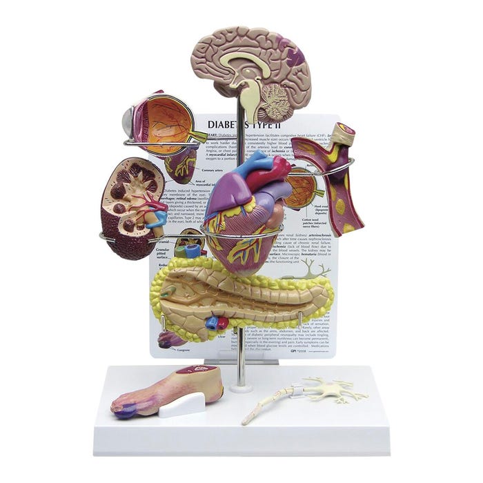 Gpi Anatomicals Type 2 Diabetes Models, 10 Inches