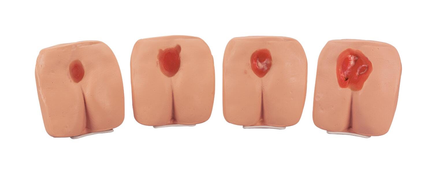 Life/form Pressure Ulcer/Bedsore Models, Light, Set of 4