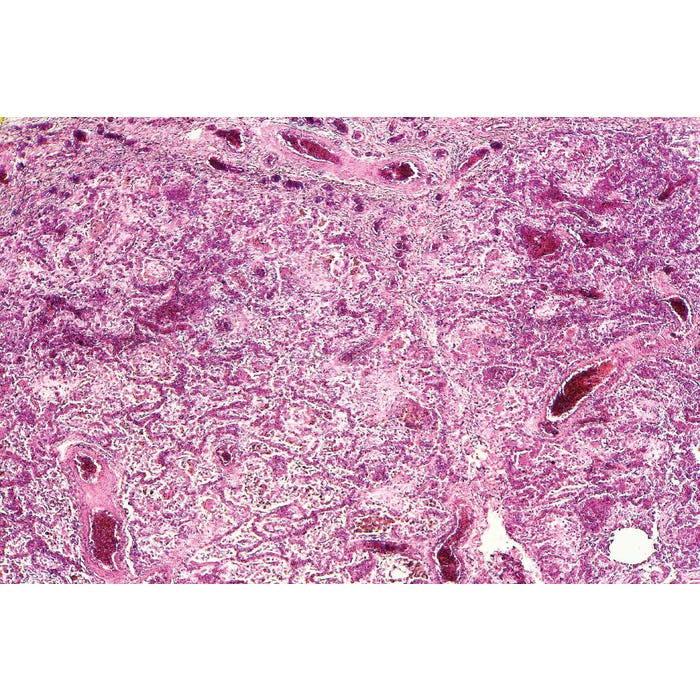 Johannes Lieder Prepared Microscope Slide, Human Lung Cancer
