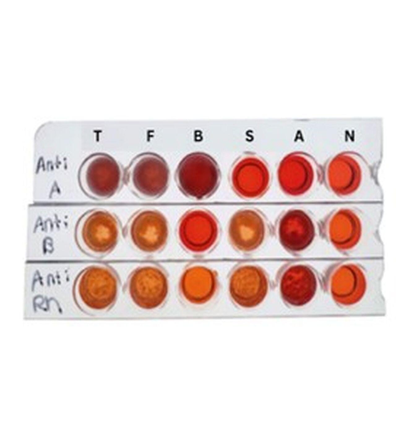 Edvotek Matchmakers in Medicine Kidney Transplant Compatibility Experiment