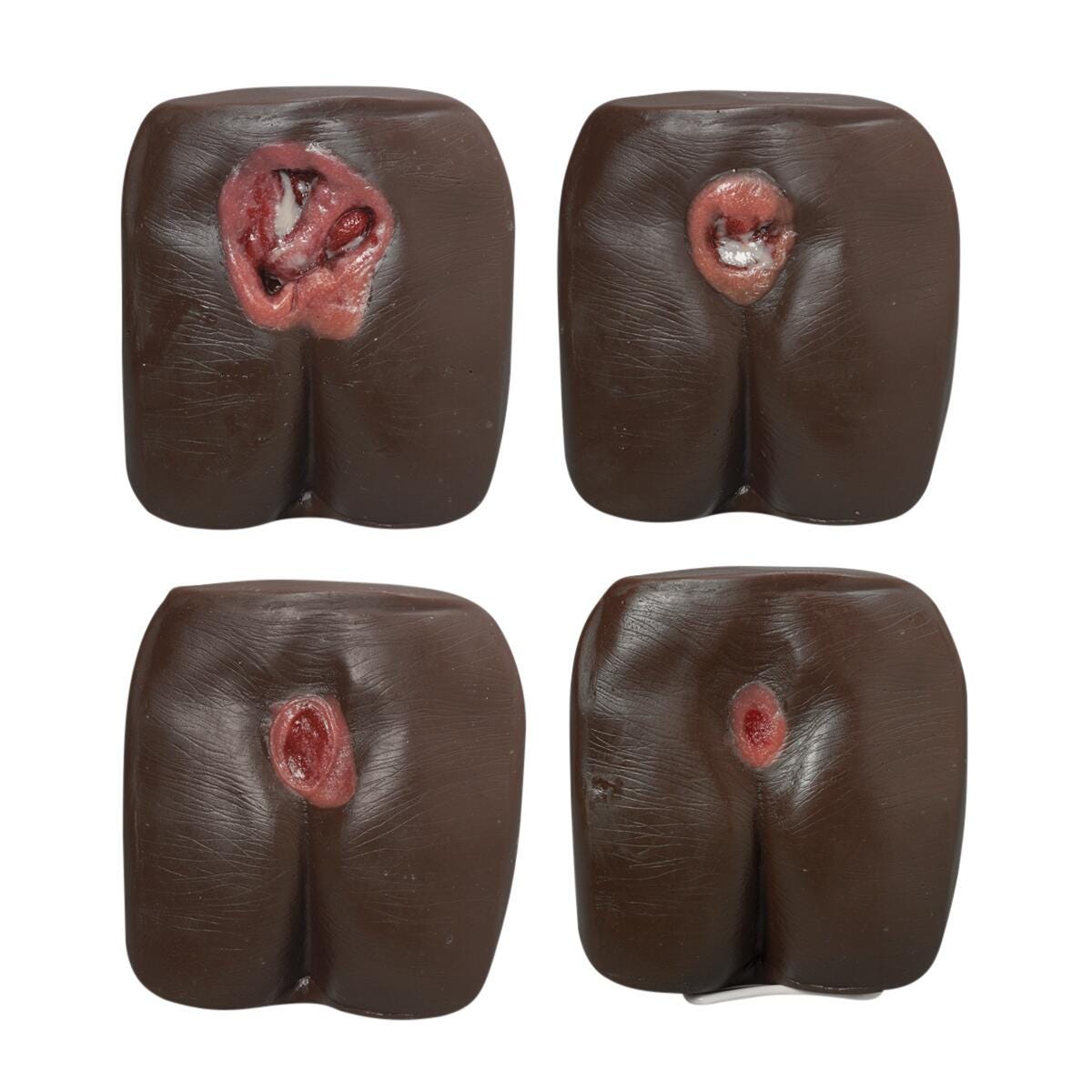 Life/form Pressure Ulcer/Bedsore Model, Dark Skin Tone