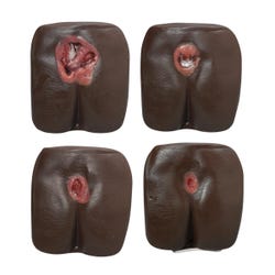 Life/form Pressure Ulcer/Bedsore Model, Dark Skin Tone